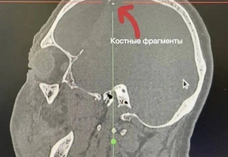 Арматурой пробило череп дачнику в Приморье