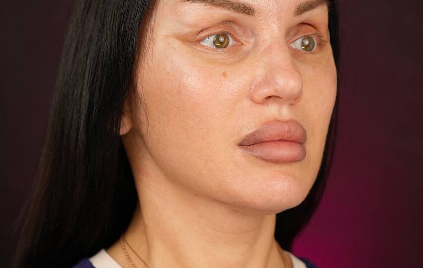 Почему сразу после подтяжки лицо может выглядеть «перетянутым