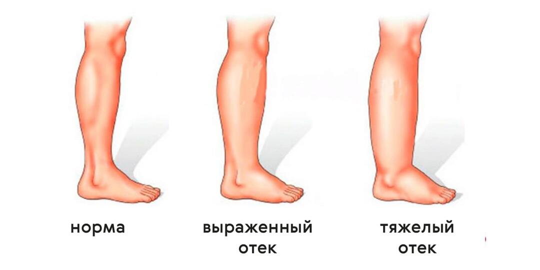 Ноги гудят и отекают к вечеру. 4 упражнения, которые заменяют компрессионку