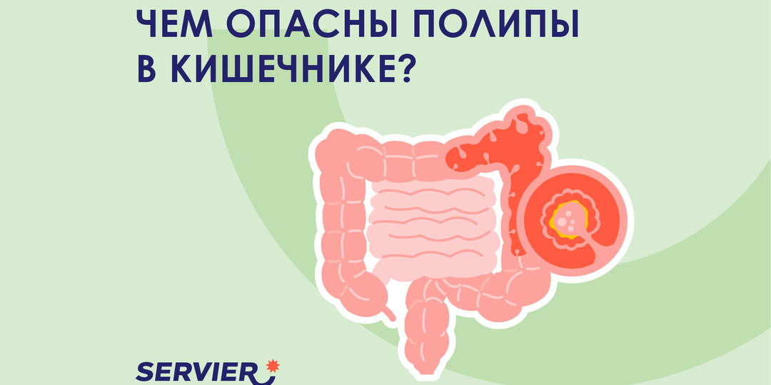 Полипы в кишечнике: чем опасны и почему их нужно удалять вовремя