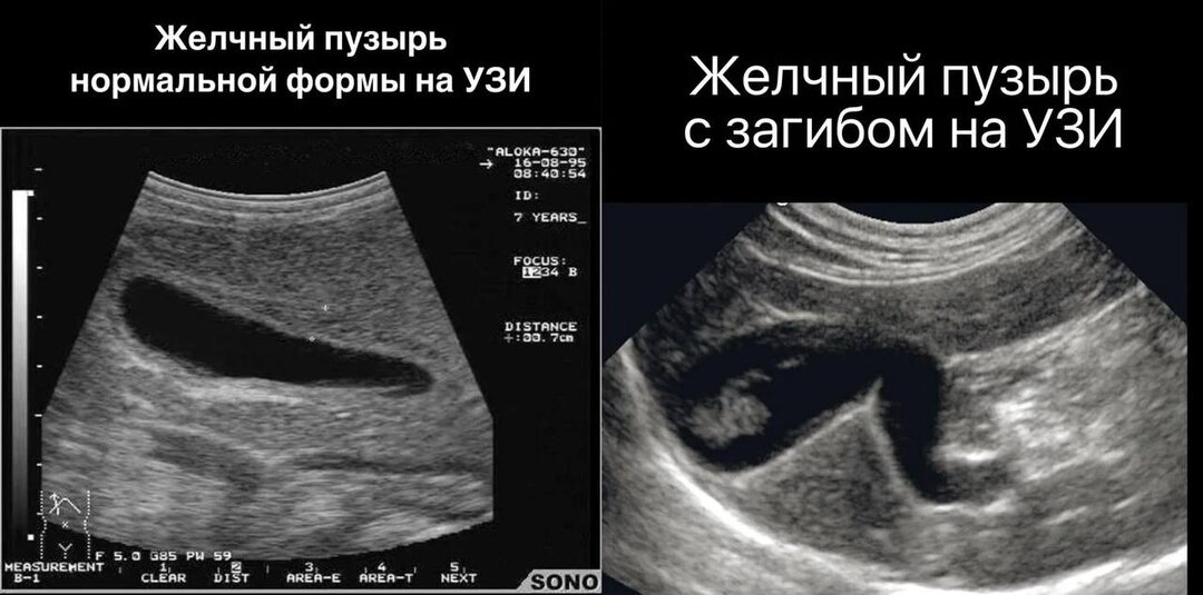 Перегиб желчного — приговор? Или просто особенность? 🤔