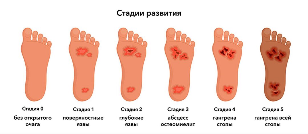 «Немые сигналы»: как распознать диабетическую нейропатию на ранней стадии