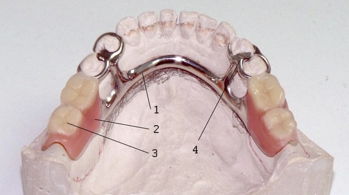 🦷 Бюгельный протез: удобная альтернатива обычному съёмному протезу