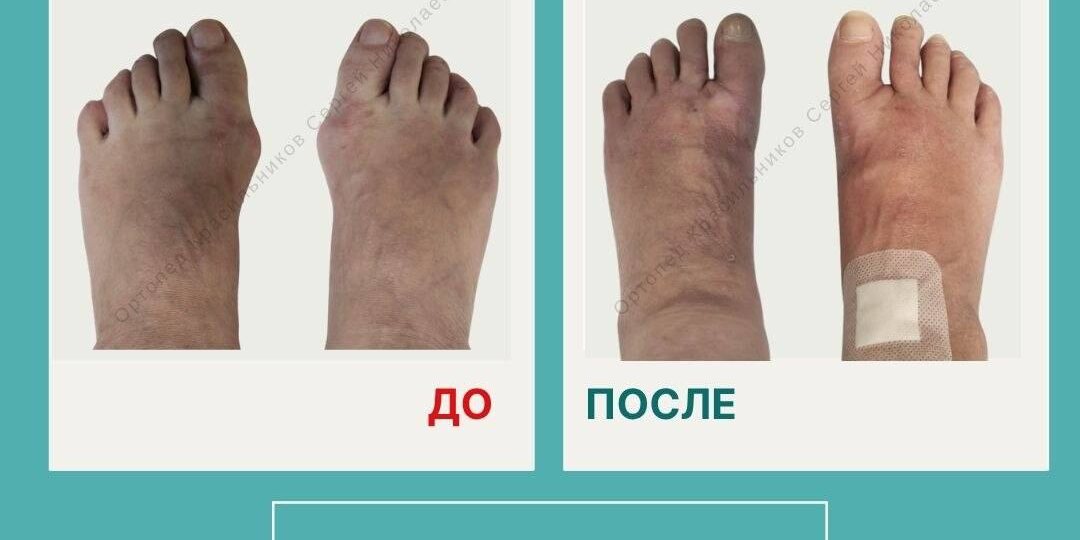 В этой подборке хочу показать не один отдельный случай, а разные варианты коррекции hallux valgus — от менее выраженных изменений до