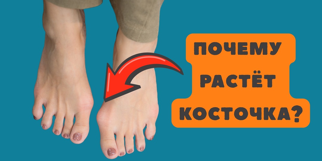 Почему растёт косточка на ноге и можно ли остановить её рост?