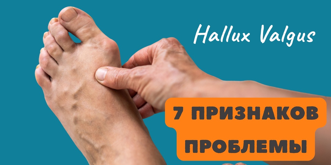 7 признаков, что косточка на ноге уже требует внимания