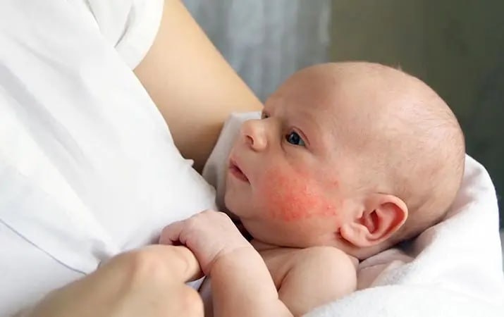 🧴 Атопический дерматит: 4 ошибки, которые я вижу каждый день в кабинете