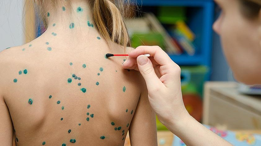 Ветрянка: не такая безобидная, как кажется. И прививка, которая того стоит