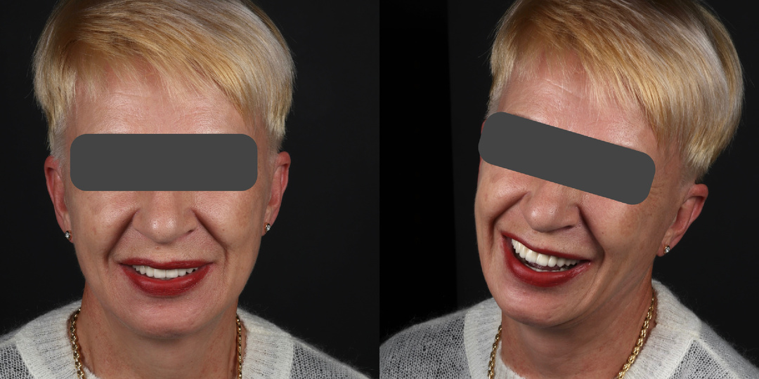 Честно о тотальной двухчелюстной работе, о которой вы не должны были узнать - получилось "всё на 4", должно было быть "всё на 6"