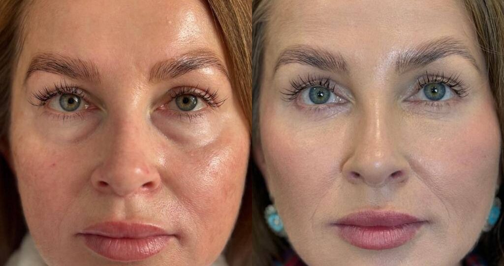 👁 У пациентки были выраженные грыжи под глазами
