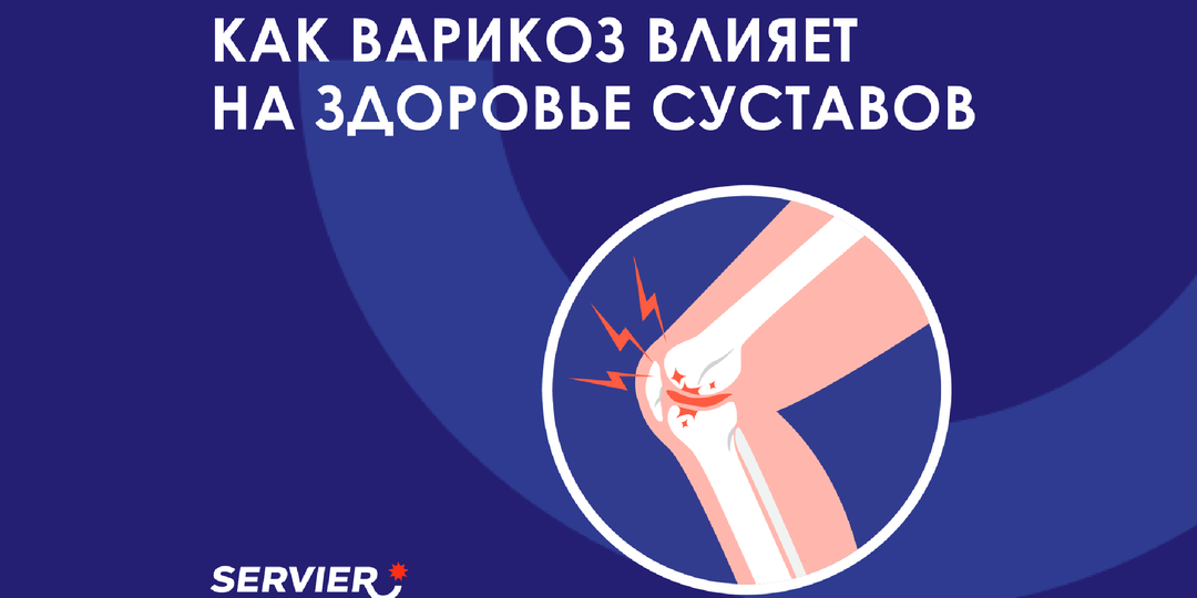 Неочевидная опасность: почему артроз и варикоз часто идут рука об руку