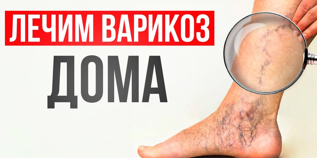 ГАЛИФЕ и сосудистые звёздочки — от одной натянутой связки! 4 простых движения для боковой стороны бедра