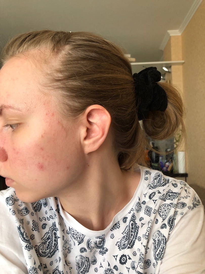 сбоку тоже обсыпало.