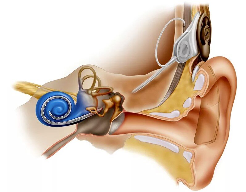 Восстановление слуха