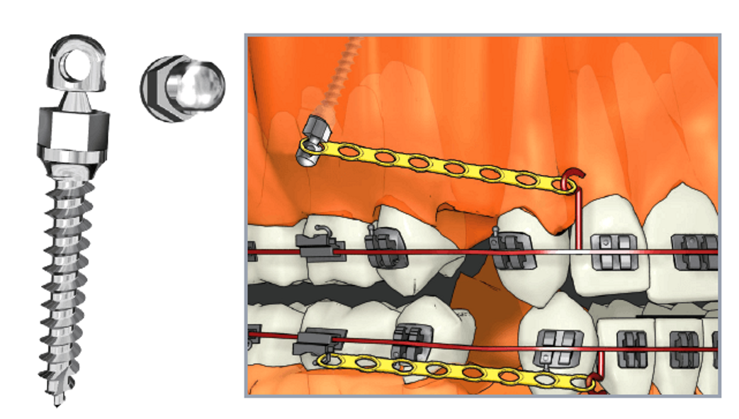 Ортодонтический имплант. Ортодонтические минивинты BIORAY. Конмет минивинты ортодонтические. Винты БИОРЕЙ ортодонтия.