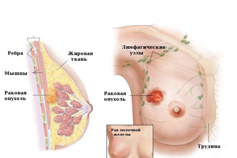 Схематичное изображение рака молочной железы