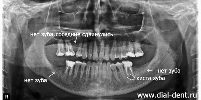 панорамный снимок до лечения