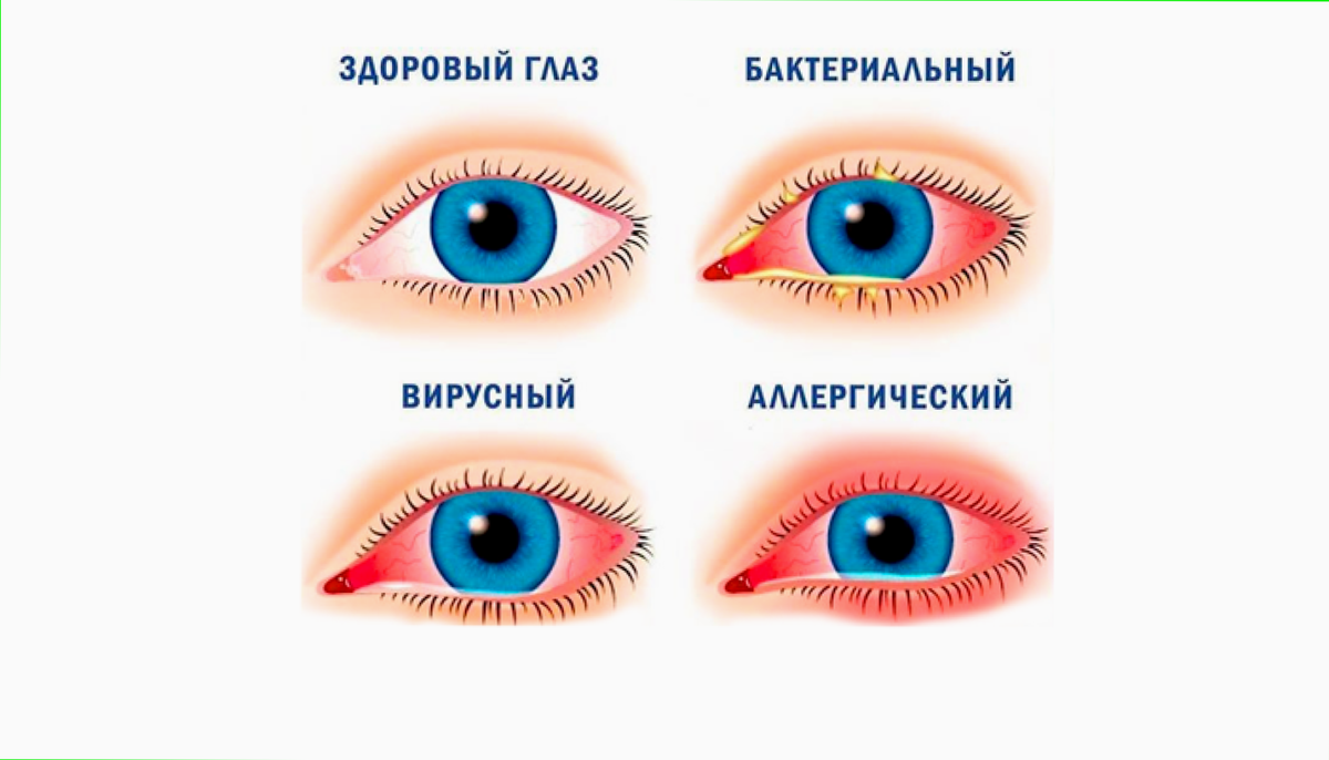 Вирусный конъюнктивит у детей. Фликтенулёзный конъюнктивит. Профилактика конъюнктивита. У ребенка конъюнктивит: лечение и профилактика. Профилактика от конъюнктивита у детей