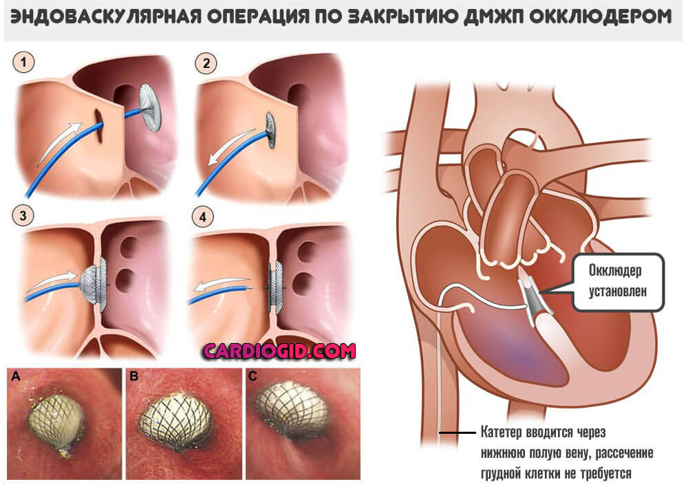 Пороки сердца - причины появления, симптомы заболевания, диагностика и способы лечения