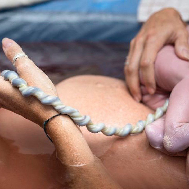 Обвитие пуповиной