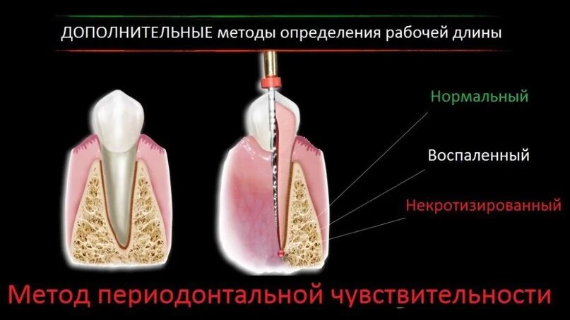 Рабочая длина. Рабочая длина корневого канала. Рабочая длина корневых каналов зуба. Табличный метод определения длины корневого канала. Методы определения рабочей длины канала зуба.