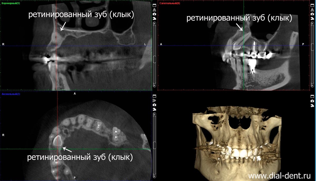 на компьютерной томограмме зубов виден ретинированный (не выросший) клык в толще кости