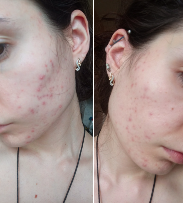 Дзен сильно портит качество изображений, в реальной жизни кожа выглядит намного более резко и, соответственно, хуже