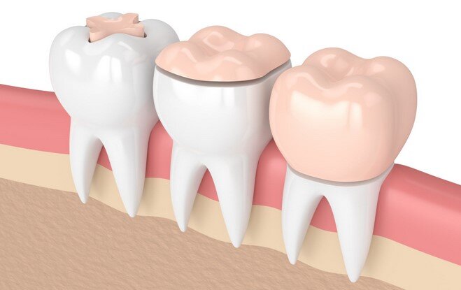 Лечение и пломбирование зубов