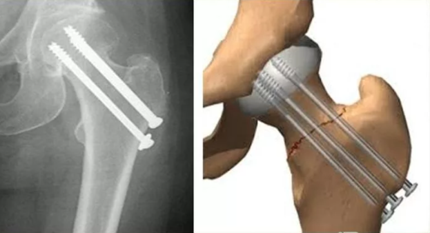 Остеосинтез трубчатых костей