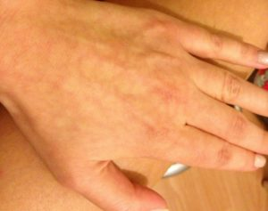 Пятнистая окраска кожи при ВСД. https://washdoctor.ru/mramornyj-cvet-kozhi-pri-vsd.html