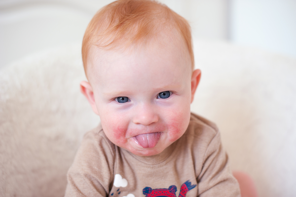 Красные щеки у ребенка. Стоит ли паниковать?