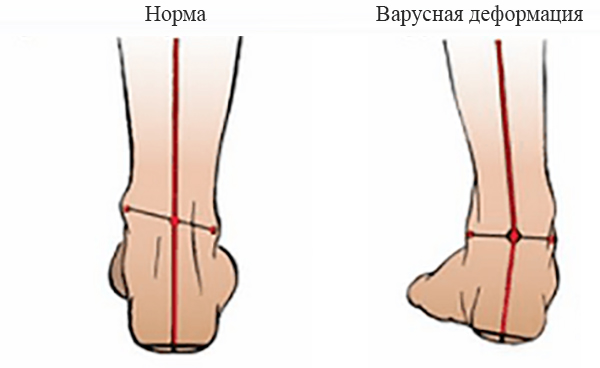 Лечебный массаж при вальгусной и плосковальгусной деформации стопы ног