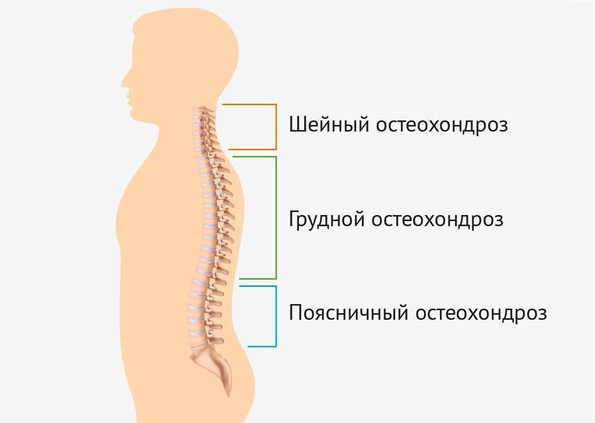 Виды остеохондроза