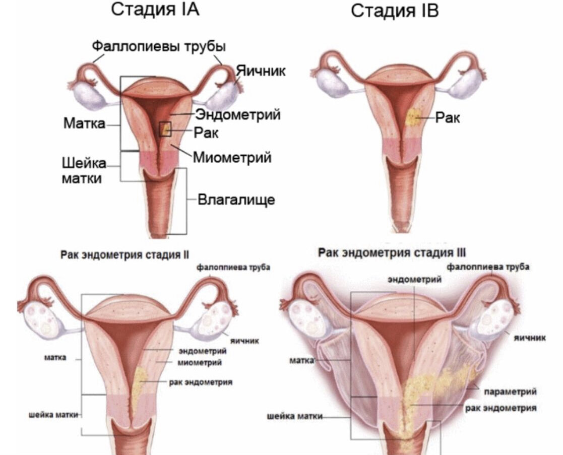Онкология эндометрия матки 1 стадия