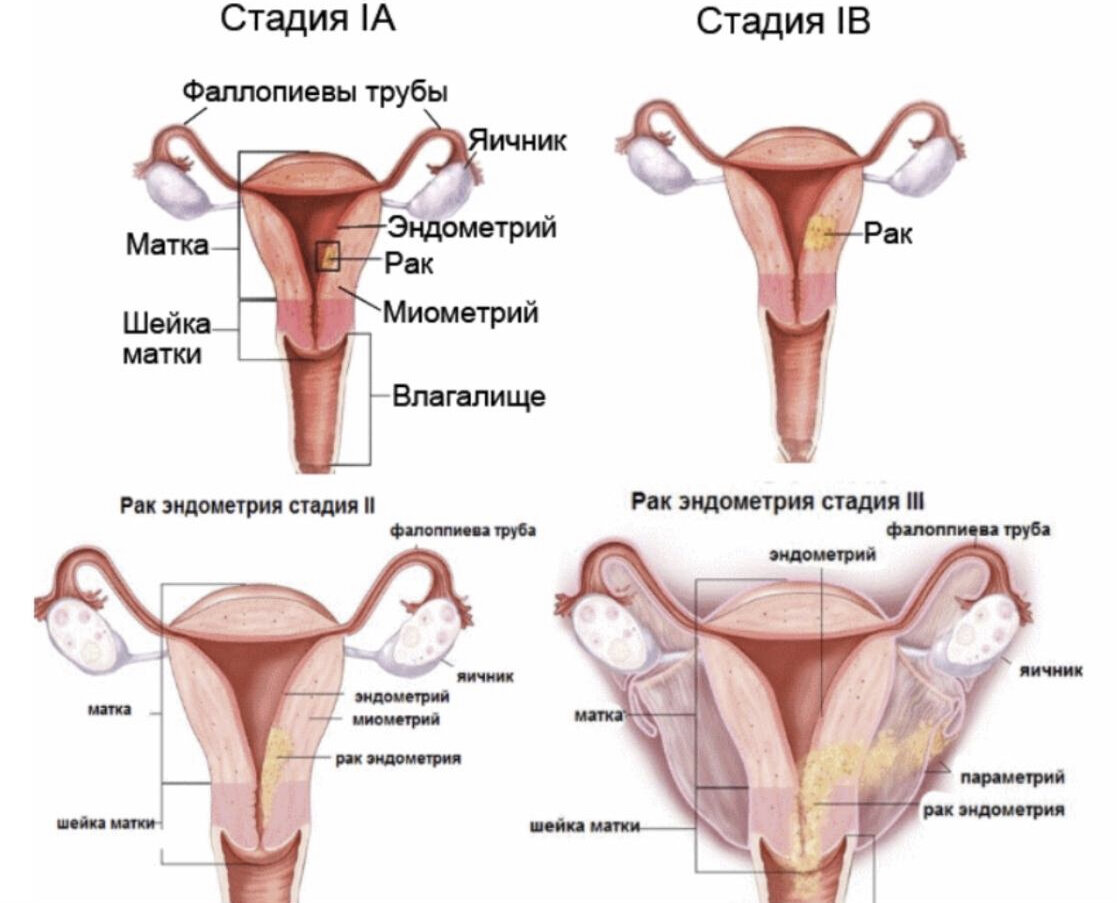 Перевязать трубы у женщины