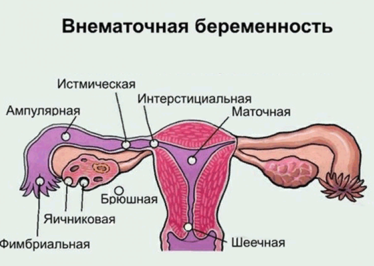 Внематочная беременность