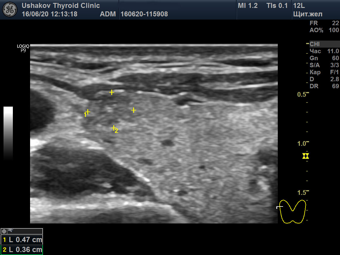 Рак щитовидной железы узи картина