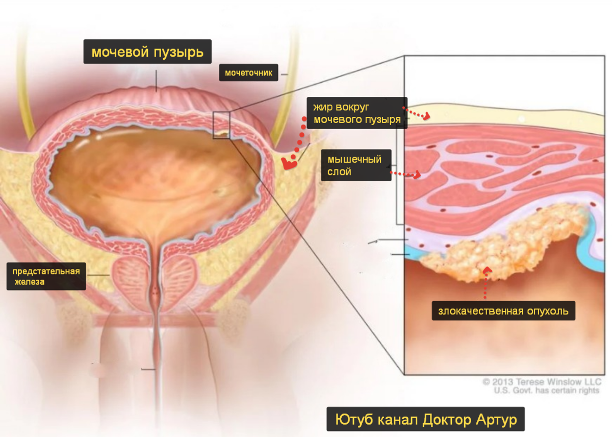 Опухоль мочевого пузыря. Раковая опухоль мочевого пузыря. Уротелиальная карцинома мочевого пузыря. Карцинома мочевого пузыря у женщин.