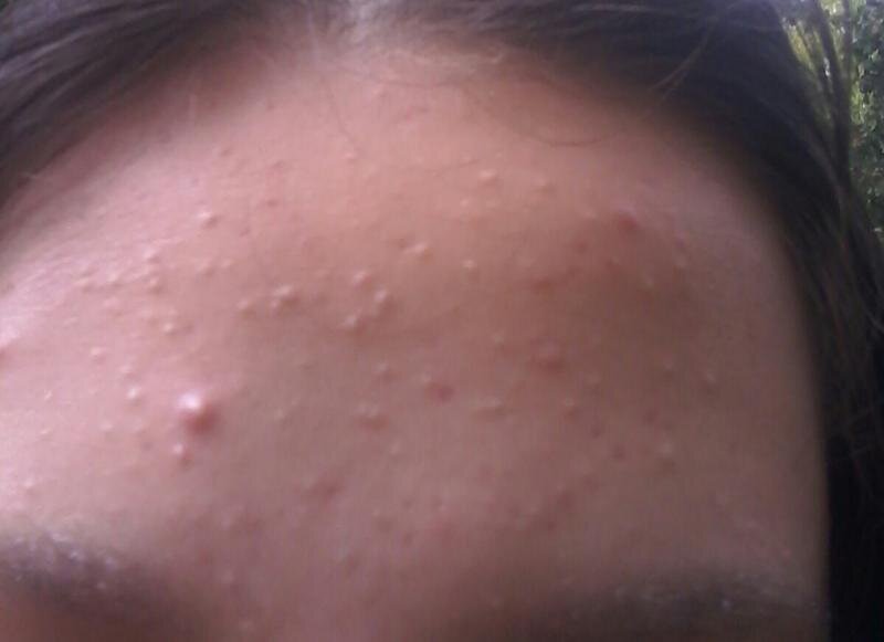 Когда на теле, а чаще всего на лице появляются прыщи, людей пытаются их скрыть при помощи косметики, даже не пытаясь определить причины появления.