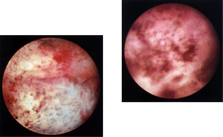 Эндомитриоз.