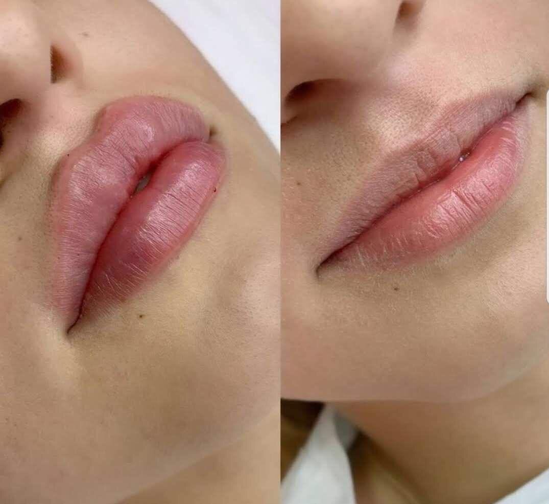 Почему филлеры в губах быстро рассасываются? Мнение врача-косметолога |  Татьяна Аюпова | Дзен