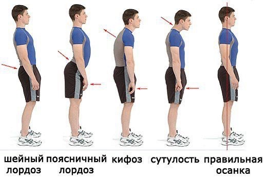 Виды нарушений осанки.