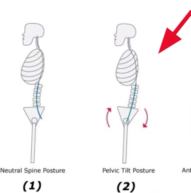 лордоз поясничного отдела позвоночника сглажен. лордоз поясничного отдела позвоночника сглажен. кифоз + лордоз поясничного отдела позвоночника. сглаженный лордоз поясничного отдела. кифоз шейно грудного отдела позвоночника.