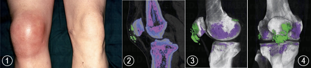 
Снимок колена 45-летнего мужчины (1)
Изображение КТ (2) позволяют диагностировать наличие подагрических тофусов, содержащих кристаллы мононатриевого урата (зеленые области)
Трехмерные реконструированные КТ-изображения с цветовой кодировкой, просматриваемые с бокового (3) и фронтального (4) аспектов колена, более точно отображают подагрические тофусы