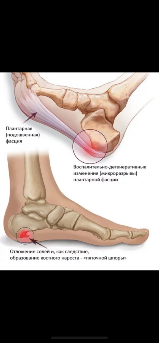 Плантарный фасциит 🦶 (подошвенный фасциоз) или пяточная шпора — это заболевание, обусловленное воспалительно-дегенеративными изменениями плантарной (подошвенной) фасции. 
🦶Подошвенный фасциит является наиболее распространенной причиной боли в пятке, которая особенно сильно ощущается в начале ходьбы (утром при первых шагах). Кроме того, при подошвенном фасциите может болеть свод стопы и лодыжка. 
😍 Крутые упр. которые вы сможете выполнять дома для борьбы с данным недугом ждут вас дальше на стр. Подписывайте 👍.                                Оставляйте комментарии✋🏻                 Ставьте ❤️                                                         Будьте здоровы !