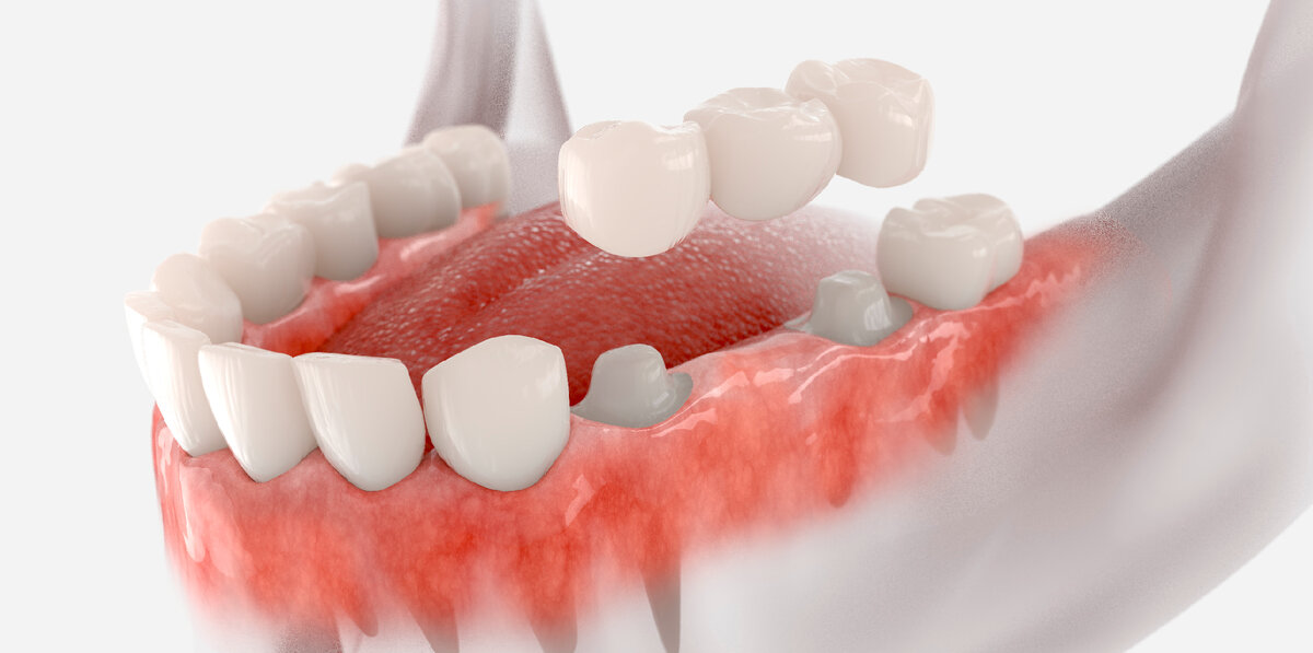 Что лучше: имплант или мост на зубы? | Epion