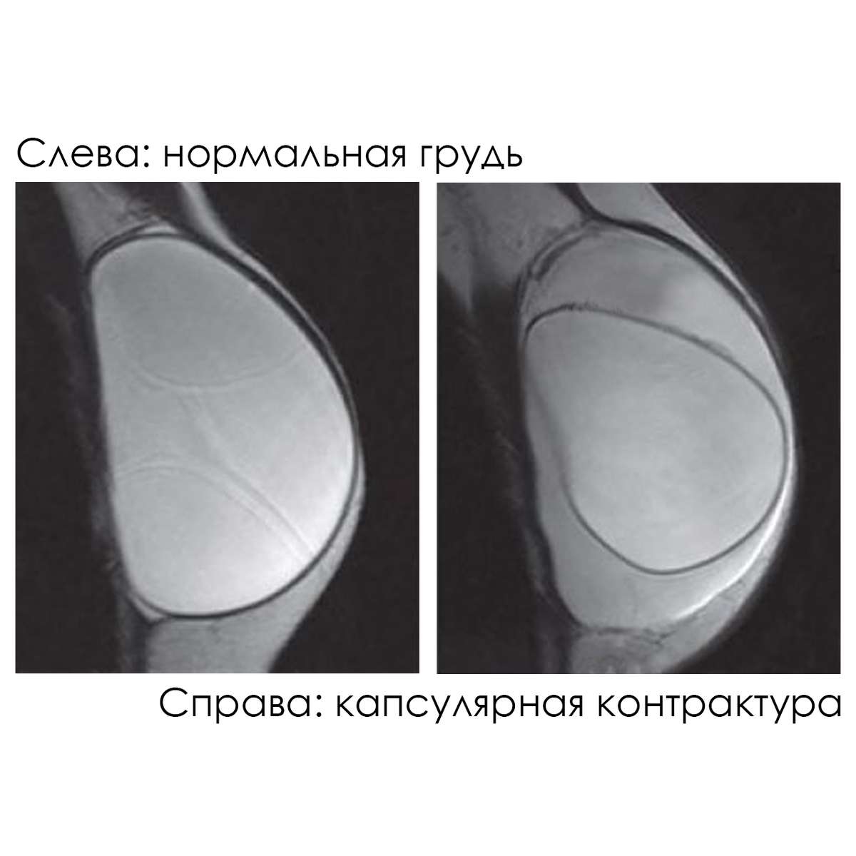 Капсулярная контрактура после маммопластики | Пластический хирург/Софья  Чаушева | Дзен