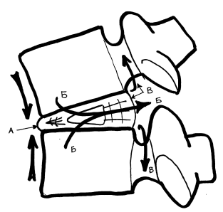 из книги В.Г. Соломатов "Межпозвонковая грыжа от "А" до "Я"