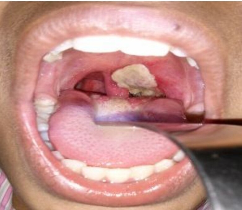 Налёты на миндалинах при дифтерии-1