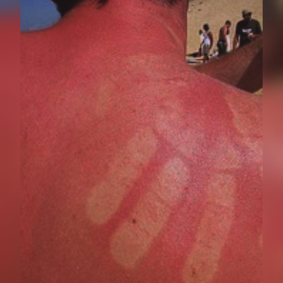 Фото я не мог сделать вот примерно такая же спина как и у меня была.